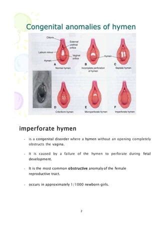 hymen foto|Hymen (Female Anatomy): Image, Functions, Diseases and。